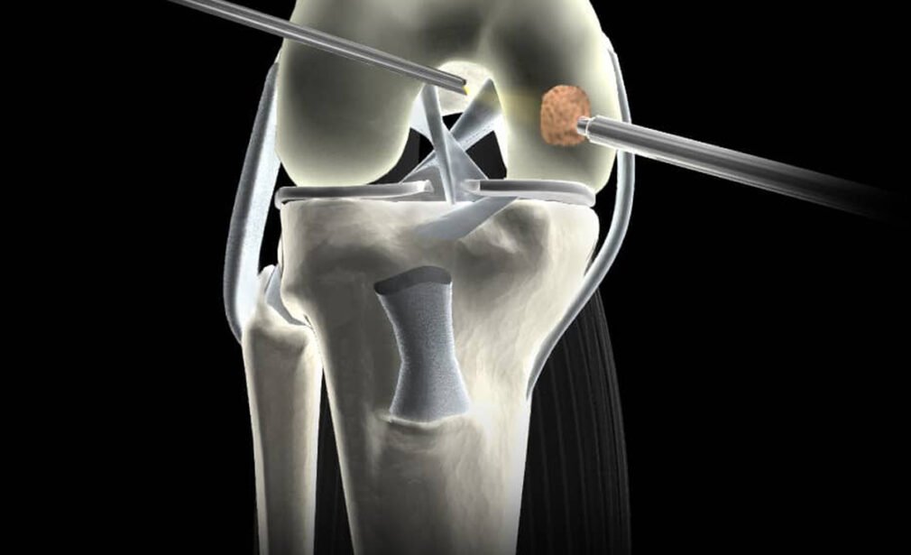 Cartilage Surgery in Ahmedabad