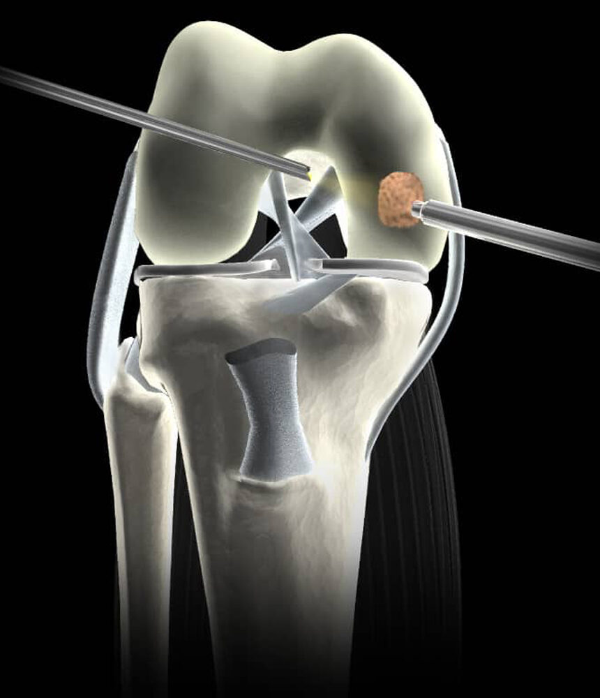 Cartilage Surgery in Ahmedabad